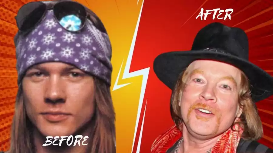 Axl Rose Before And After